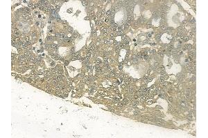 ABIN6255345 and ABIN6267144 at 1/100 staining human ovarian carcinoma by IHC-P. (NEDD4-2 抗体  (pSer448))