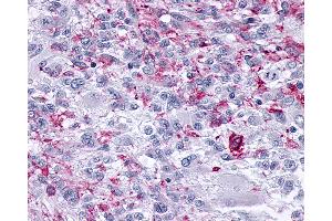 Anti-OPRM1 / Mu Opioid Receptor antibody IHC of human Brain, Glioblastoma. (Mu Opioid Receptor 1 抗体  (C-Term))