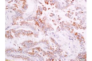 Paraformaldehyde-fixed, paraffin embedded human lung carcinoma tissue, Antigen retrieval by boiling in sodium citrate buffer(pH6) for 15min, Block endogenous peroxidase by 3% hydrogen peroxide for 30 minutes, Blocking buffer (normal goat serum) at 37°C for 20min, Antibody incubation with Rabbit Anti-CD300A/C Polyclonal Antibody, Unconjugated  at 1:200 overnight at 4°C, followed by a conjugated secondary and DAB staining (CD300A/ C (AA 20-70) 抗体)