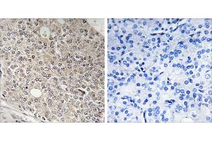 Peptide - +Immunohistochemistry analysis of paraffin-embedded human prostate carcinoma tissue using AMOTL1 antibody.