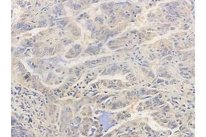 ABIN6255718 and ABIN6267407 at 1/100 staining human lung adenocarcinoma by IHC-P. (PKC alpha 抗体  (pThr638))