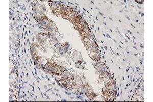 Immunohistochemical staining of paraffin-embedded Adenocarcinoma of Human ovary tissue using anti-MGLL mouse monoclonal antibody. (MGLL 抗体)