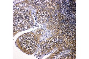 Anti-NOX2/gp91phox antibody, IHC(P) IHC(P): Human Intestinal Cancer Tissue (CYBB 抗体  (Middle Region))