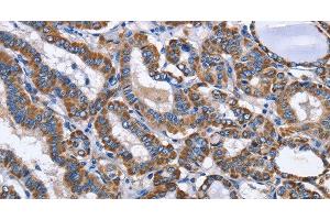 Immunohistochemistry of paraffin-embedded Human thyroid cancer using INTS10 Polyclonal Antibody at dilution of 1:50 (INTS10 抗体)