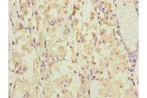 Immunohistochemistry of paraffin-embedded human gastric cancer using ABIN7149316 at dilution of 1:100 (DYNC1I1 抗体  (AA 1-220))