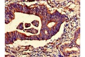 Immunohistochemistry of paraffin-embedded human colon cancer using ABIN7151278 at dilution of 1:100 (TRIM4 抗体  (AA 1-118))