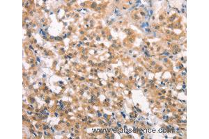 Immunohistochemistry of Human liver cancer using LATS2 Polyclonal Antibody at dilution of 1:30 (LATS2 抗体)