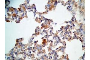 Rat lung cancer tissue stained by Rabbit Anti-CRAMP (Mouse) Antibody (Cathelicidin 抗体  (AA 140-173))