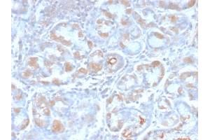 Formalin-fixed, paraffin-embedded human Stomach Carcinoma stained with pS2 Rabbit Recombinant Monoclonal Antibody (TFF1/2969R).
