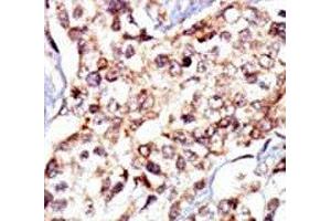IHC analysis of FFPE human breast carcinoma tissue stained with the c-Src antibody (Src 抗体  (AA 1-30))