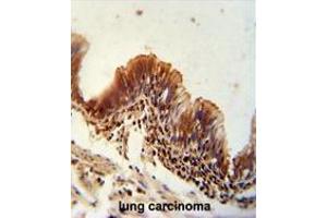 TXNDC6 antibody (Center) immunohistochemistry analysis in formalin fixed and paraffin embedded human lung carcinoma followed by peroxidase conjugation of the secondary antibody and DAB staining. (NME9 抗体  (Middle Region))