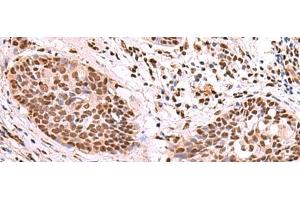 Immunohistochemistry of paraffin-embedded Human esophagus cancer tissue using SF3B3 Polyclonal Antibody at dilution of 1:70(x200) (SF3B3 抗体)