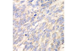 Immunohistochemistry of paraffin-embedded human esophageal cancer using DLD antibody. (DLD 抗体  (AA 36-300))