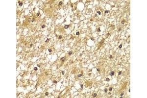 Immunohistochemistry of paraffin-embedded Human brain cancer using PIK3R3 Polyclonal Antibody at dilution of 1:100 (40x lens). (PIK3R3 抗体)