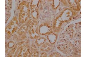 Immunohistochemistry of paraffin-embedded human colon cancer using ABIN7174308 at dilution of 1:100 (USP3 抗体  (C-Term))