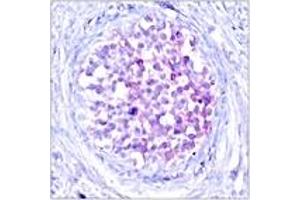 Immunohistochemistry analysis of paraffin-embedded human breast carcinoma, using C-RAF (Phospho-Ser259) Antibody. (RAF1 抗体  (AA 225-274))