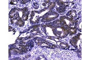 IHC analysis of GOLPH3 using anti-GOLPH3 antibody (ABIN6719570). (GOLPH3 抗体  (AA 56-298))