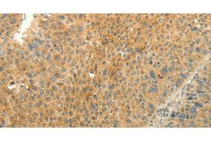 Immunohistochemistry of paraffin-embedded Human liver cancer tissue using EDG7 Polyclonal Antibody at dilution 1:40 (LPAR3 抗体)