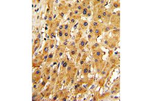 Formalin-fixed and paraffin-embedded human hepatocarcinoma with RT Antibody (N-term), which was peroxidase-conjugated to the secondary antibody, followed by DAB staining. (APRT 抗体  (N-Term))