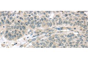 Immunohistochemistry of paraffin-embedded Human lung cancer using THAP4 Polyclonal Antibody at dilution of 1/30 (THAP4 抗体)