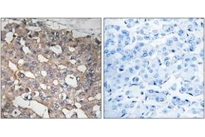 Immunohistochemistry analysis of paraffin-embedded human breast carcinoma tissue, using STMN1 (Ab-62) Antibody. (Stathmin 1 抗体  (AA 26-75))