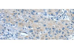 Immunohistochemistry of paraffin-embedded Human liver cancer using TNIP1 Polyclonal Antibody at dilution of 1/35 (TNIP1 抗体)