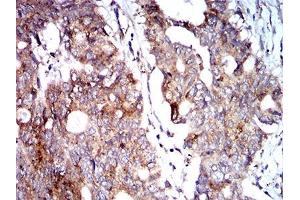 Immunohistochemical analysis of paraffin-embedded rectum cancer tissues using BNIP3 mouse mAb with DAB staining. (BNIP3 抗体  (AA 50-155))