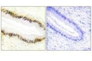 Immunohistochemistry analysis of paraffin-embedded human cervix carcinoma tissue using NR2F6 antibody.