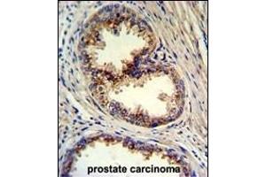 Formalin-fixed and paraffin-embedded human prostate carcinoma reacted with GOLPH3 Antibody (N-term), which was peroxidase-conjugated to the secondary antibody, followed by DAB staining. (GOLPH3 抗体  (N-Term))