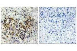 Immunohistochemistry analysis of paraffin-embedded human breast carcinoma tissue, using IRX3 antibody. (IRX3 抗体)