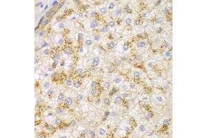 Immunohistochemistry of paraffin-embedded human liver cancer using ACTN1 antibody. (ACTN1 抗体)
