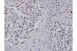 IHC-P Image Immunohistochemical analysis of paraffin-embedded human lung cancer patient tumor, using RPA 14 kDa subunit , antibody at 1:100 dilution. (RPA3 抗体)