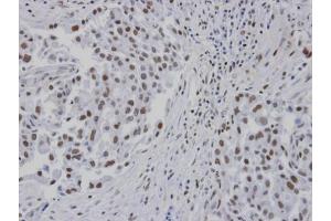 IHC-P Image Immunohistochemical analysis of paraffin-embedded human lung cancer patient tumor, using RPA 14 kDa subunit , antibody at 1:100 dilution. (RPA3 抗体)