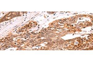 Immunohistochemistry of paraffin-embedded Human esophagus cancer tissue using RRP8 Polyclonal Antibody at dilution of 1:80(x200) (RRP8 抗体)