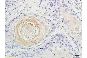 Formalin-fixed and paraffin embedded human oral squamous cell carcinoma labeled with Anti-IL-17 Polyclonal Antibody, Unconjugated at 1:200 followed by conjugation to the secondary antibody and DAB staining (IL-17 抗体  (AA 35-130))