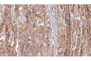 ABIN6267114 at 1/100 staining Human thyroid cancer tissue by IHC-P. (EEF2K 抗体  (pSer366))