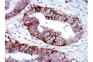 Immunohistochemical analysis of paraffin-embedded ovarian cancer tissues using IGF1R-Beta mouse mAb with DAB staining. (IGF1R 抗体  (AA 1101-1367))