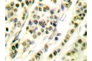 Immunohistochemistry analyzes of Skp1 p19 antibody in paraffin-embedded human breast carcinoma tissue. (SKP1 抗体)