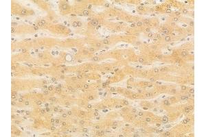 ABIN7097165 and ABIN7101233 at 1/100 staining human hepatocellular carcinoma by IHC-P. (XYLB 抗体)