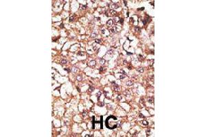 Formalin-fixed and paraffin-embedded human hepatocellular carcinoma tissue reacted with STUB1 polyclonal antibody  , which was peroxidase-conjugated to the secondary antibody, followed by AEC staining. (STUB1 抗体  (AA 160-190))