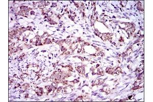 Immunohistochemical analysis of paraffin-embedded cervical cancer tissues using DNAL4 mouse mAb with DAB staining. (DNAL4 抗体  (AA 1-105))