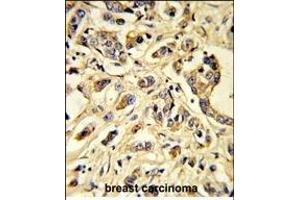 Formalin-fixed and paraffin-embedded human breast carcinoma reacted with VGFR1 Antibody, which was peroxidase-conjugated to the secondary antibody, followed by DAB staining. (FLT1 抗体)