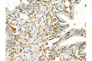 ABIN6265635 and ABIN6276636 at 1/100 staining Human prostate cancer by IHC-P.
