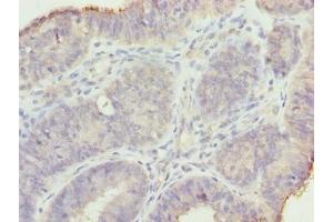 Immunohistochemistry of paraffin-embedded human endometrial cancer using ABIN7159191 at dilution of 1:100 (MND1 抗体  (AA 2-205))
