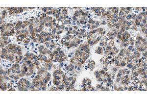 ABIN6276063 at 1/100 staining Human liver cancer tissue by IHC-P. (NPY5R 抗体  (Internal Region))