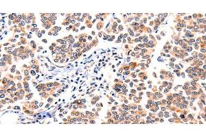 Immunohistochemistry of paraffin-embedded Human breast cancer using GNRHR Polyclonal Antibody at dilution of 1:117 (GNRHR 抗体)