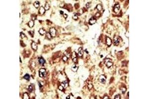 IHC analysis of FFPE human hepatocarcinoma tissue stained with the WEE1 antibody (WEE1 抗体  (AA 604-634))