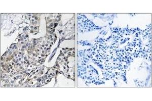 Immunohistochemistry analysis of paraffin-embedded human breast carcinoma, using GBP4 Antibody. (GBP4 抗体  (AA 551-600))