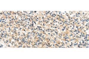 Immunohistochemistry of paraffin-embedded Human prostate cancer tissue using TTI1 Polyclonal Antibody at dilution 1:40 (TTI1 抗体)