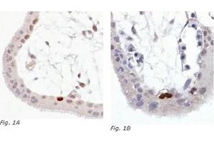 Immunohistochemistry (IHC) image for anti-Tumor Protein P53 (TP53) (AA 378-393), (C-Term), (pSer392) antibody (ABIN238404) (p53 抗体  (C-Term, pSer392))